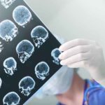 Чип в мозгу позволил общаться силой мысли